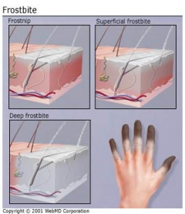 Frostbite schematic and image -- © WebMD.